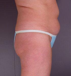 Liposuction Before & After Image