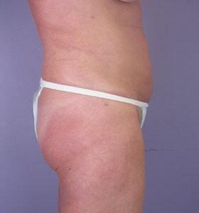 Liposuction Before & After Image