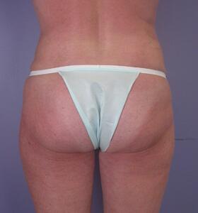 Liposuction Before & After Image