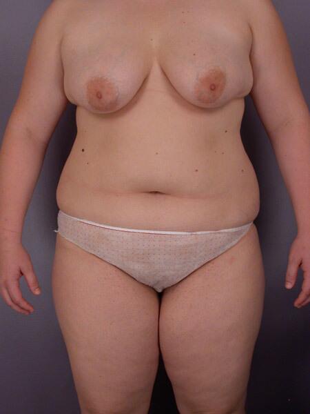 Liposuction Before & After Image