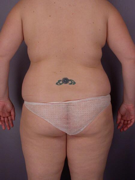 Liposuction Before & After Image