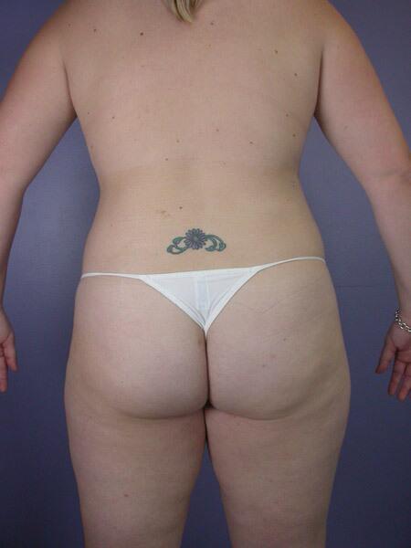 Liposuction Before & After Image