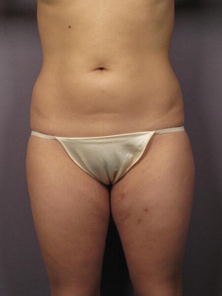 Liposuction Before & After Image