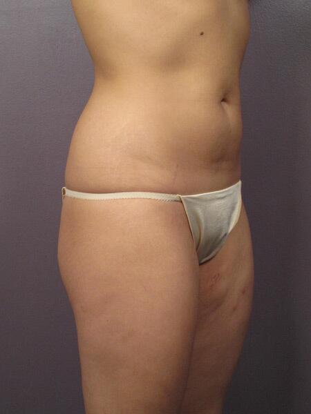 Liposuction Before & After Image