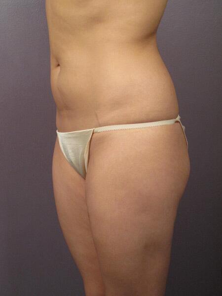 Liposuction Before & After Image