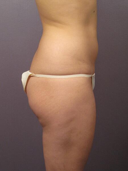 Liposuction Before & After Image