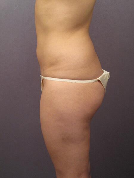 Liposuction Before & After Image