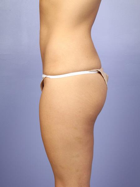 Liposuction Before & After Image