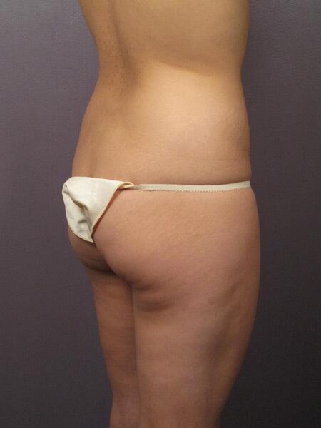 Liposuction Before & After Image