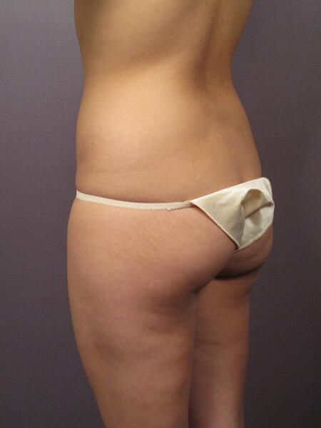 Liposuction Before & After Image