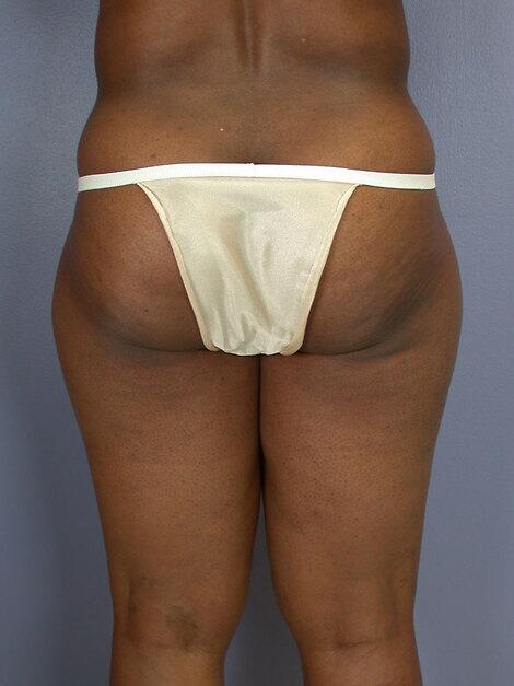 Liposuction Before & After Image