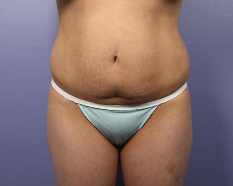 Liposuction Before & After Image