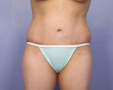 Liposuction Before & After Image