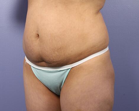 Liposuction Before & After Image