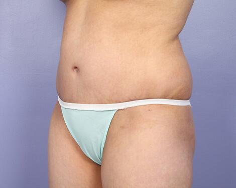 Liposuction Before & After Image