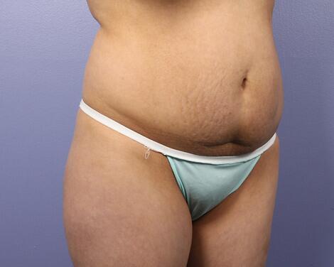 Liposuction Before & After Image