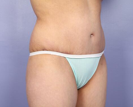 Liposuction Before & After Image