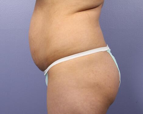 Liposuction Before & After Image