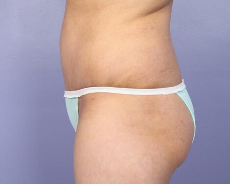 Liposuction Before & After Image