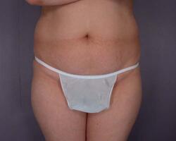 Liposuction Before & After Image