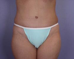 Liposuction Before & After Image