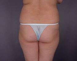 Liposuction Before & After Image