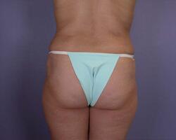 Liposuction Before & After Image