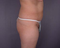 Liposuction Before & After Image