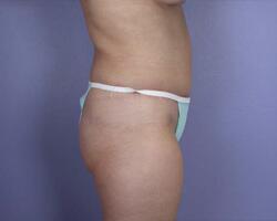 Liposuction Before & After Image