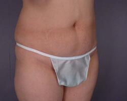 Liposuction Before & After Image