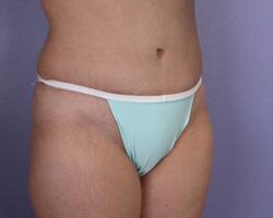 Liposuction Before & After Image