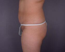 Liposuction Before & After Image