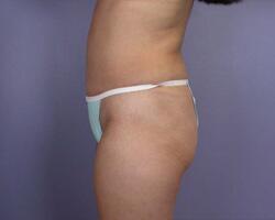 Liposuction Before & After Image