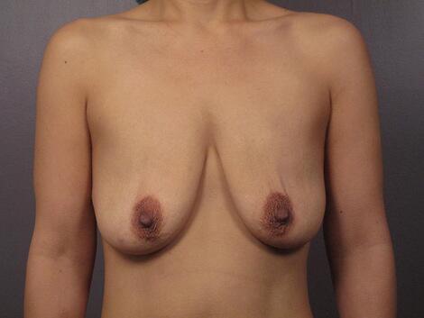 Liposuction Before & After Image