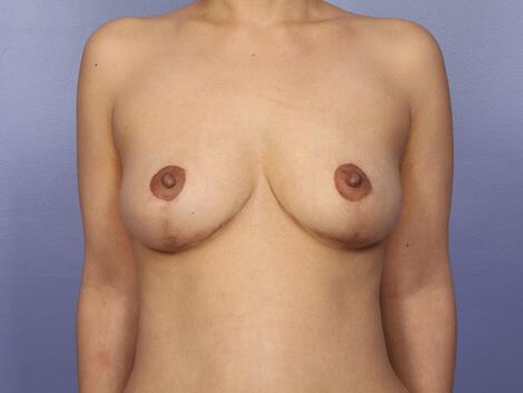 Liposuction Before & After Image