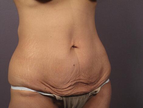 Liposuction Before & After Image