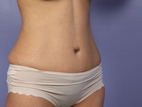 Liposuction Before & After Image