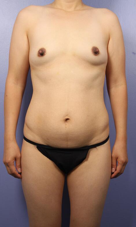 Liposuction Before & After Image