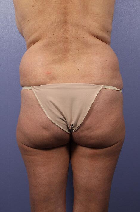 Liposuction Before & After Image