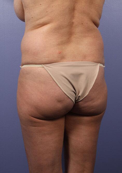 Liposuction Before & After Image