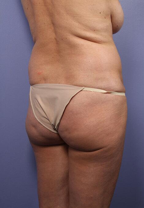 Liposuction Before & After Image