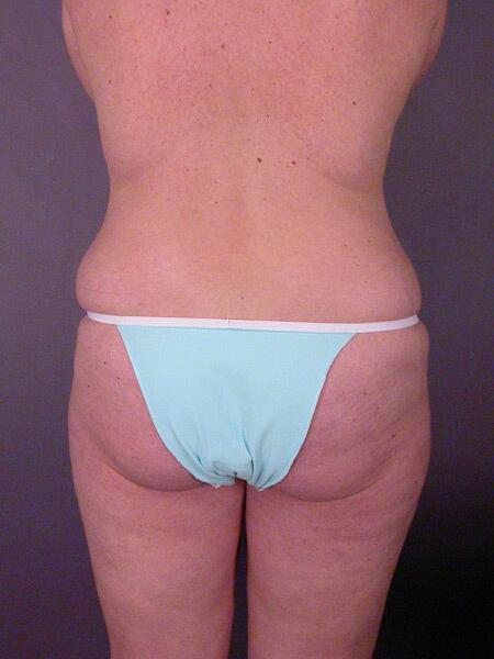 Liposuction Before & After Image