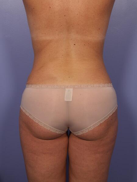 Liposuction Before & After Image