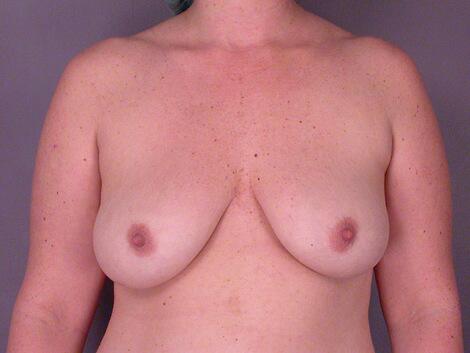 Liposuction Before & After Image