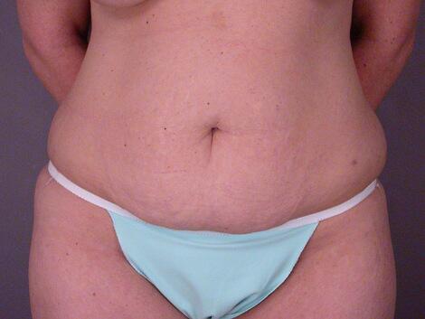 Liposuction Before & After Image