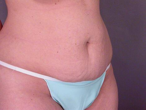 Liposuction Before & After Image