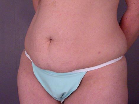 Liposuction Before & After Image