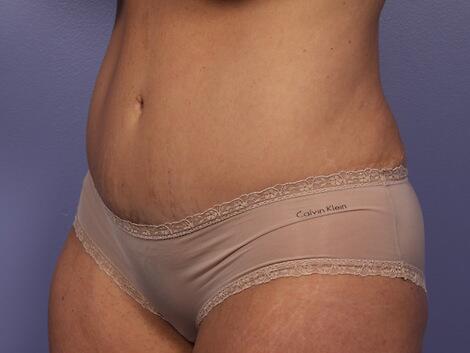 Liposuction Before & After Image