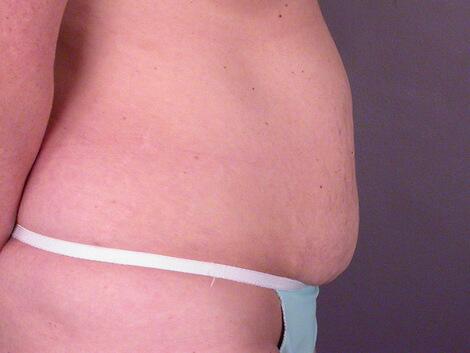 Liposuction Before & After Image