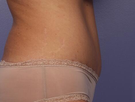 Liposuction Before & After Image